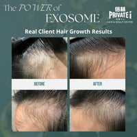 Buy "RETRO-EXOSOME Hair Consolidation & Renewal Treatment" for HKD980 and get a complimentary "O2 Jet Plus Deep Cleansing Scalp Treatment" (Original Price: $980)