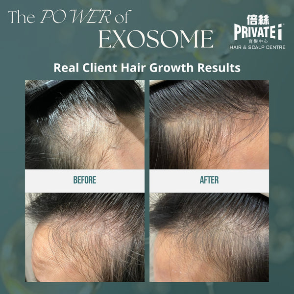 Buy "RETRO-EXOSOME Hair Consolidation & Renewal Treatment" for HKD980 and get a complimentary "O2 Jet Plus Deep Cleansing Scalp Treatment" (Original Price: $980)